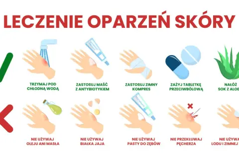 Domowe sposoby na oparzenia po spawaniu: chłodna woda, maść z antybiotykiem, zimny kompres, aloes. Unikaj masła, jajek, pasty do zębów, lodu.